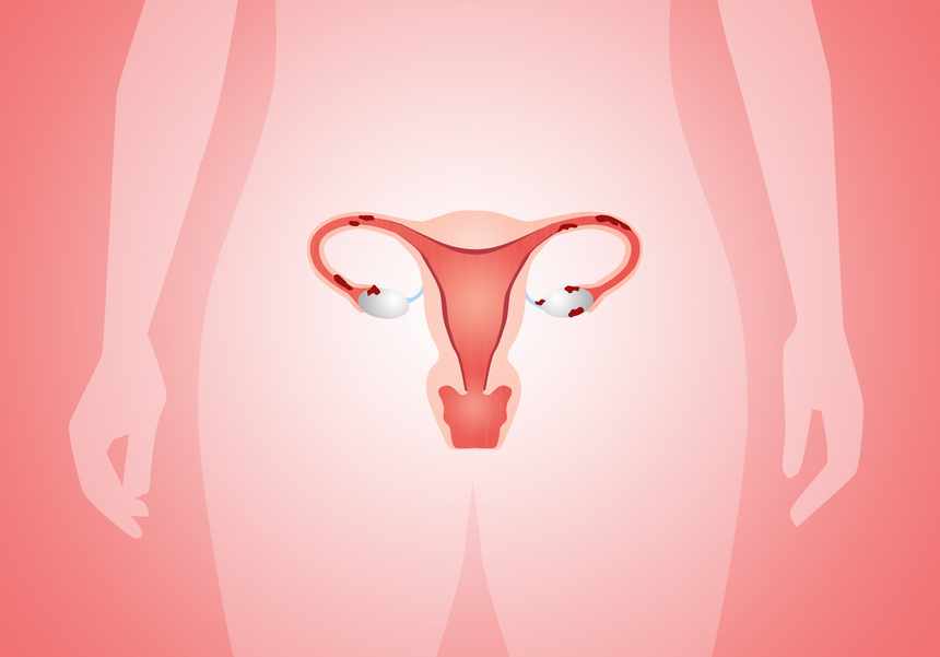 Endometriosis - illustration